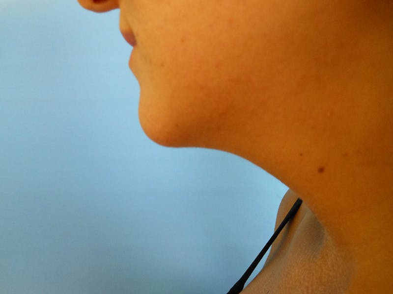 Neck Before & After Gallery - Patient 51821649 - Image 1
