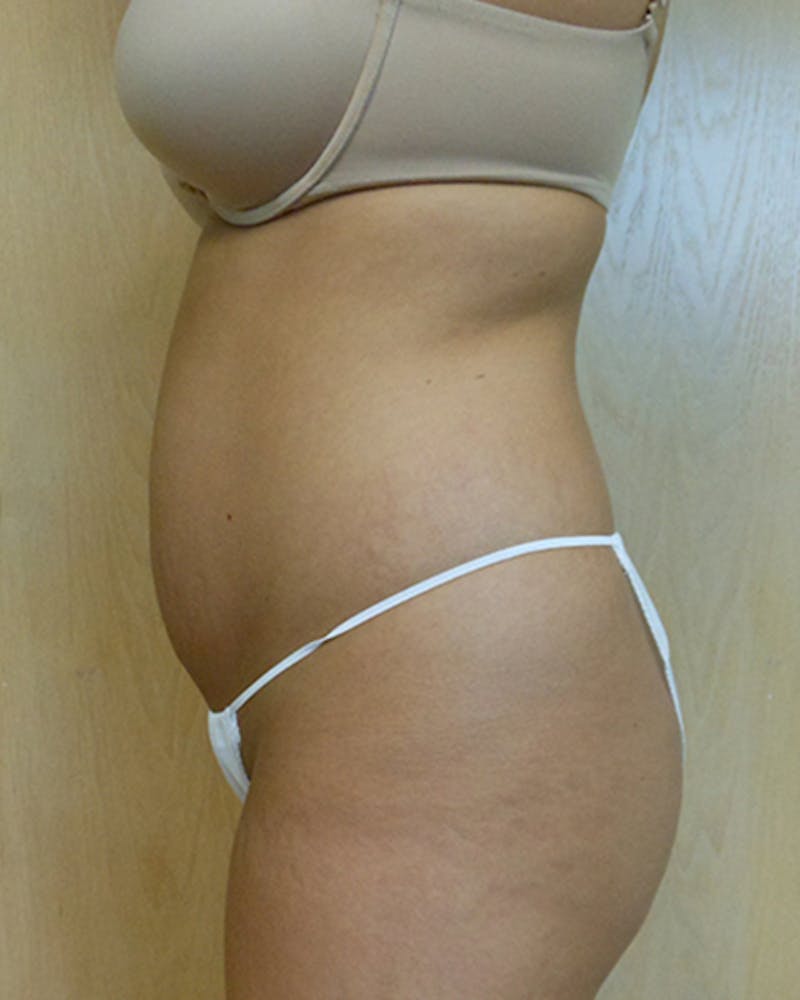 Abdomen Before & After Gallery - Patient 51821650 - Image 3