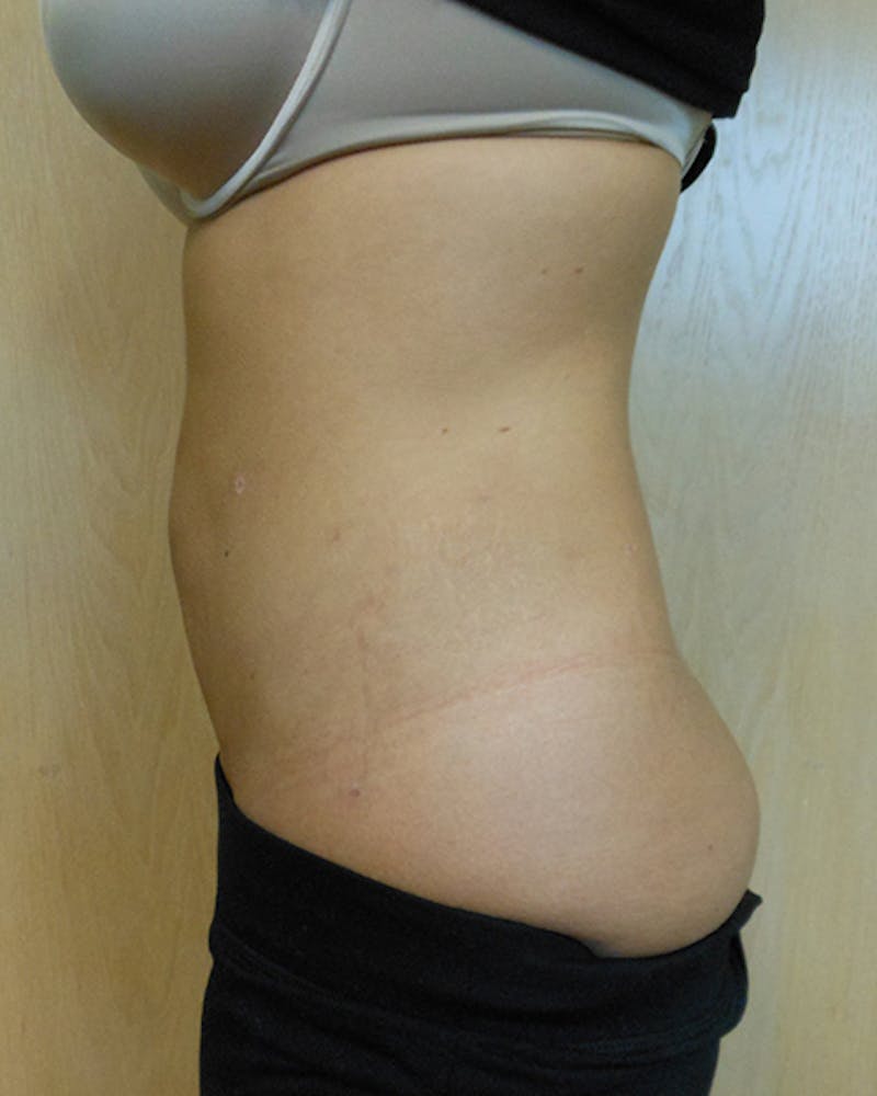 Abdomen Before & After Gallery - Patient 51821650 - Image 4