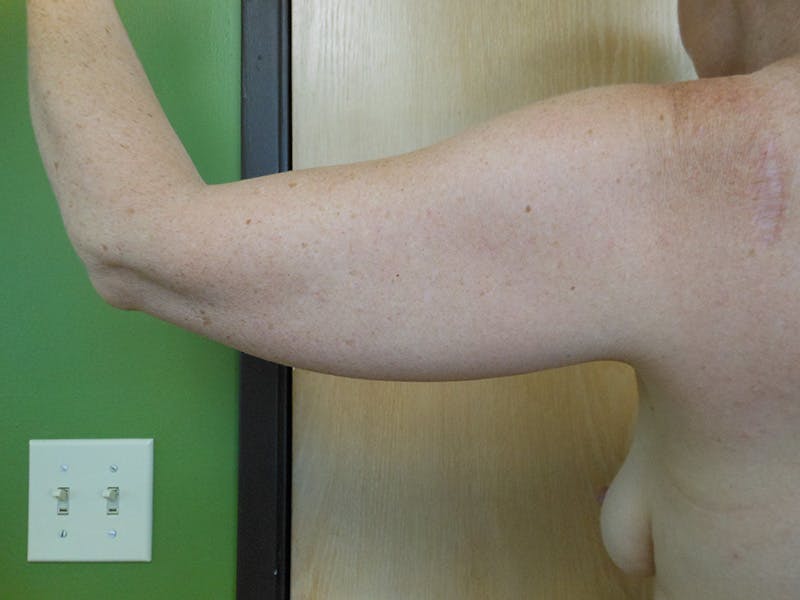 Arms Before & After Gallery - Patient 51821651 - Image 3