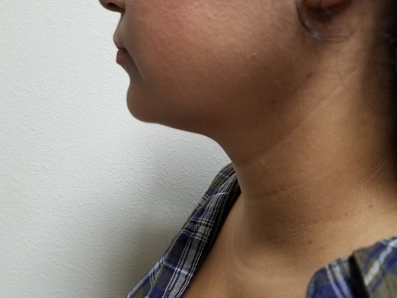Neck Before & After Gallery - Patient 51821654 - Image 2
