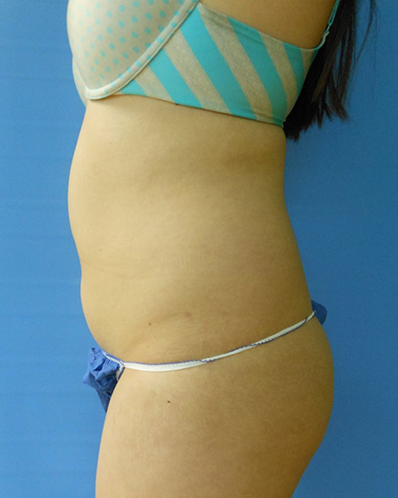 Abdomen Before & After Gallery - Patient 51821652 - Image 1