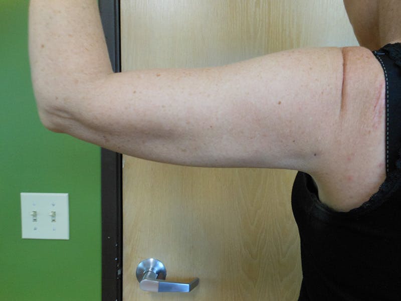 Arms Before & After Gallery - Patient 51821651 - Image 4