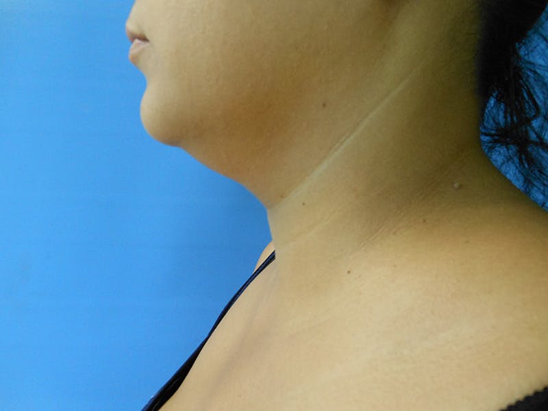 Neck Before & After Gallery - Patient 51821654 - Image 3