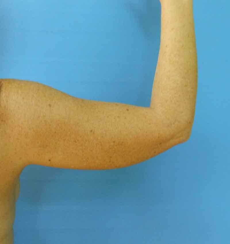 Arms Before & After Gallery - Patient 51821653 - Image 1