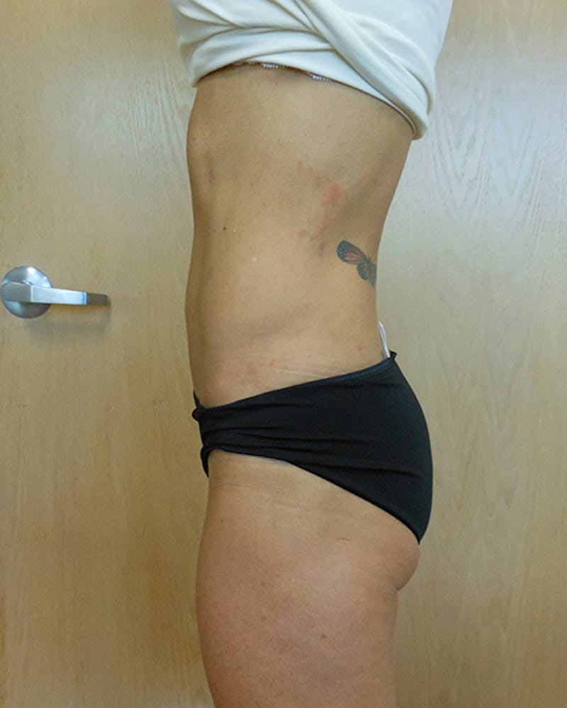 Abdomen Before & After Gallery - Patient 51821655 - Image 2