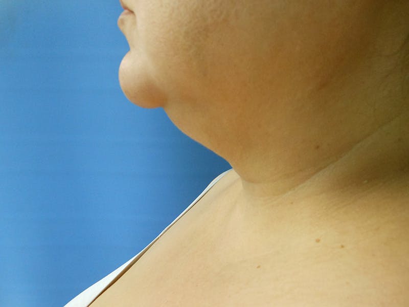 Neck Before & After Gallery - Patient 51821658 - Image 1