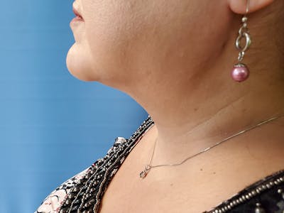 Neck Before & After Gallery - Patient 51821658 - Image 2