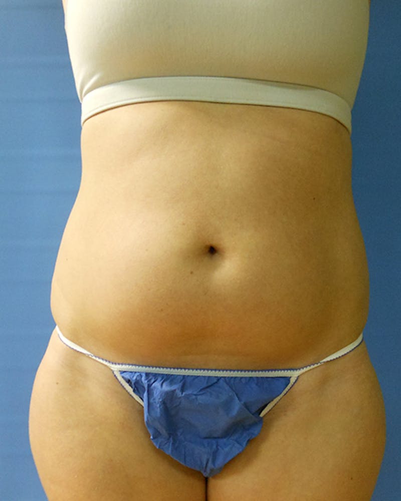 Abdomen Before & After Gallery - Patient 51821660 - Image 1