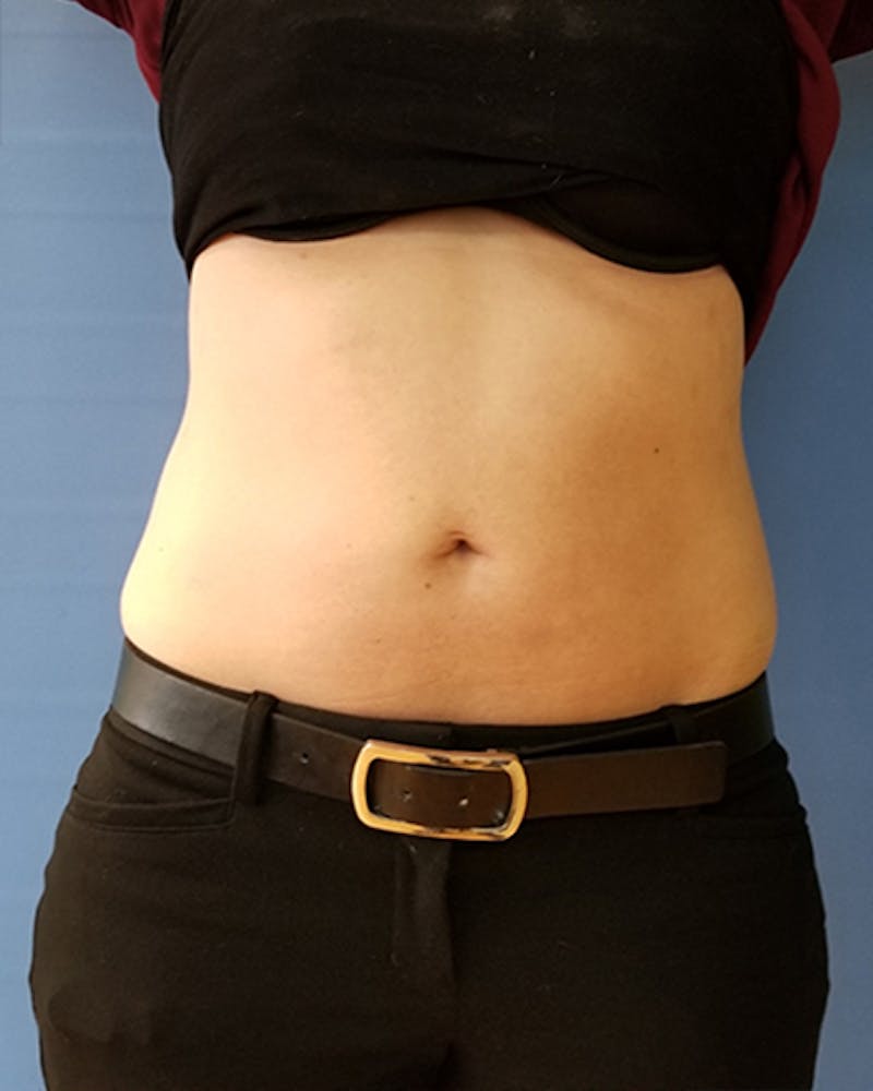 Abdomen Before & After Gallery - Patient 51821660 - Image 2