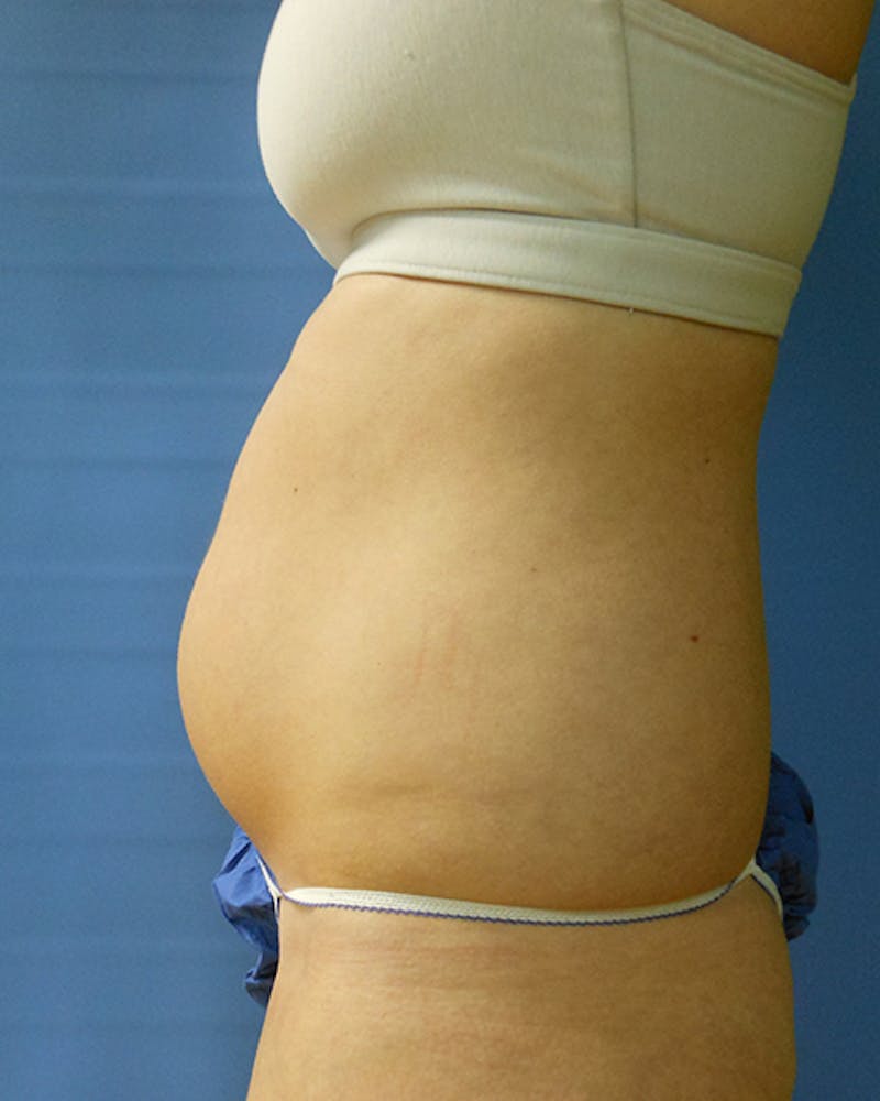 Abdomen Before & After Gallery - Patient 51821660 - Image 3
