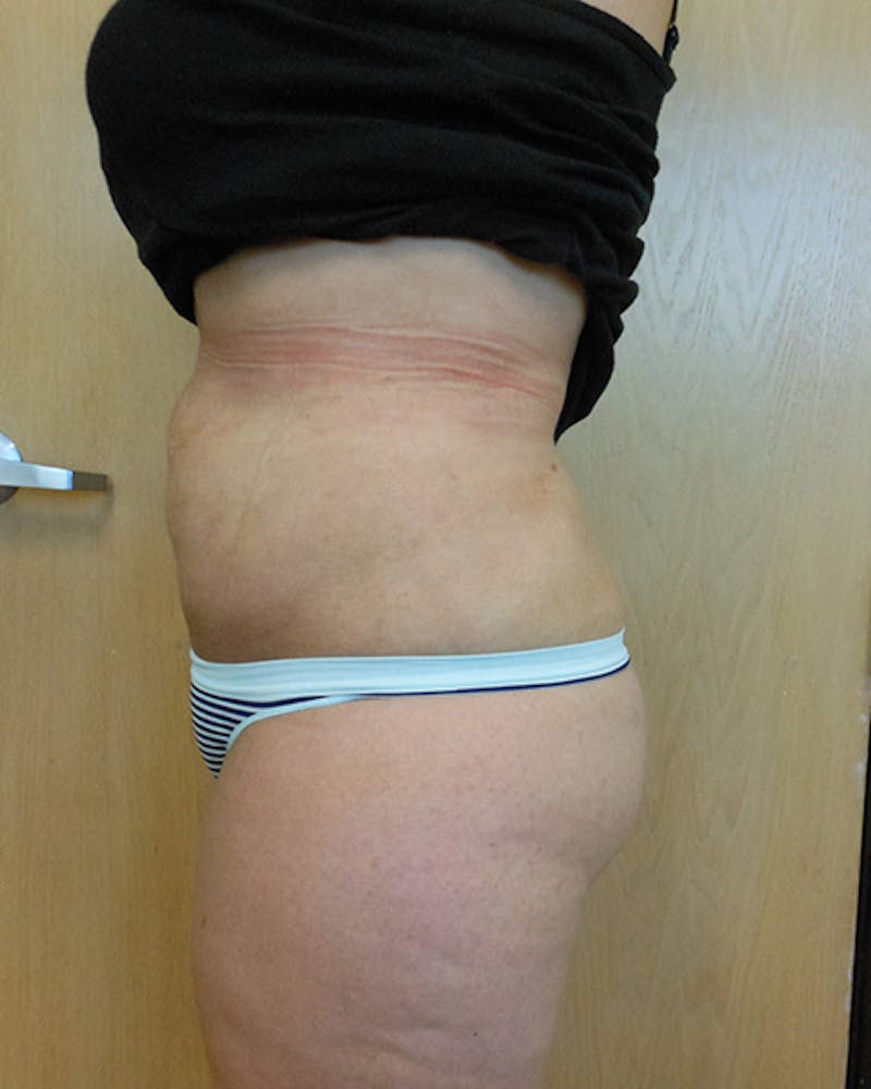 Abdomen Before & After Gallery - Patient 51821662 - Image 2