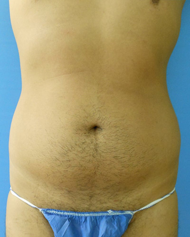 Abdomen Before & After Gallery - Patient 51821663 - Image 1