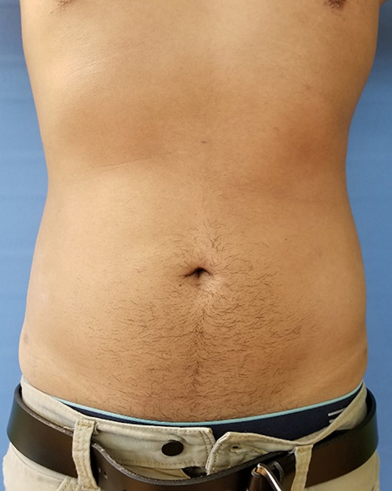 Abdomen Before & After Gallery - Patient 51821663 - Image 2