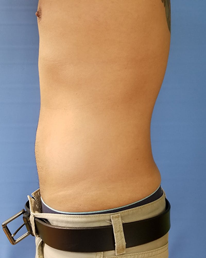 Abdomen Before & After Gallery - Patient 51821663 - Image 4