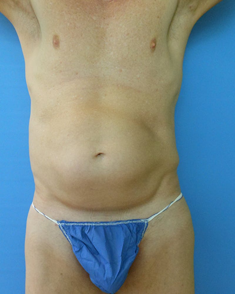 Abdomen Before & After Gallery - Patient 51821664 - Image 1