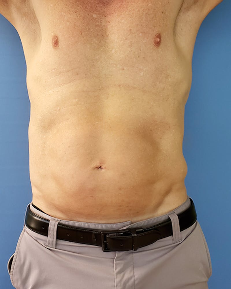 Abdomen Before & After Gallery - Patient 51821664 - Image 2