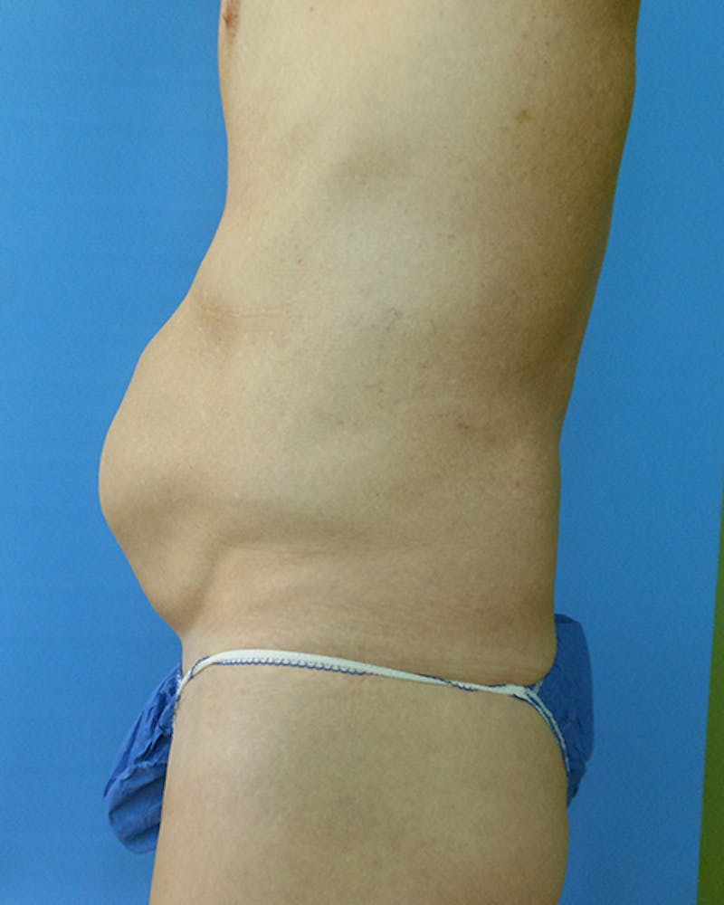 Abdomen Before & After Gallery - Patient 51821664 - Image 3