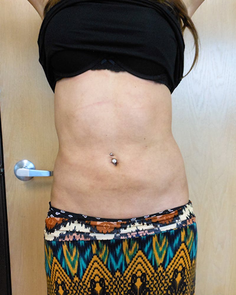 Abdomen Before & After Gallery - Patient 51821665 - Image 2