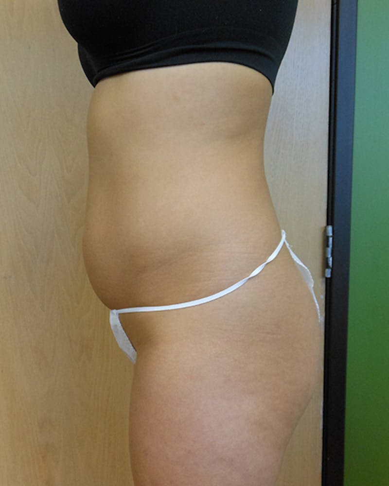 Abdomen Before & After Gallery - Patient 51821665 - Image 3