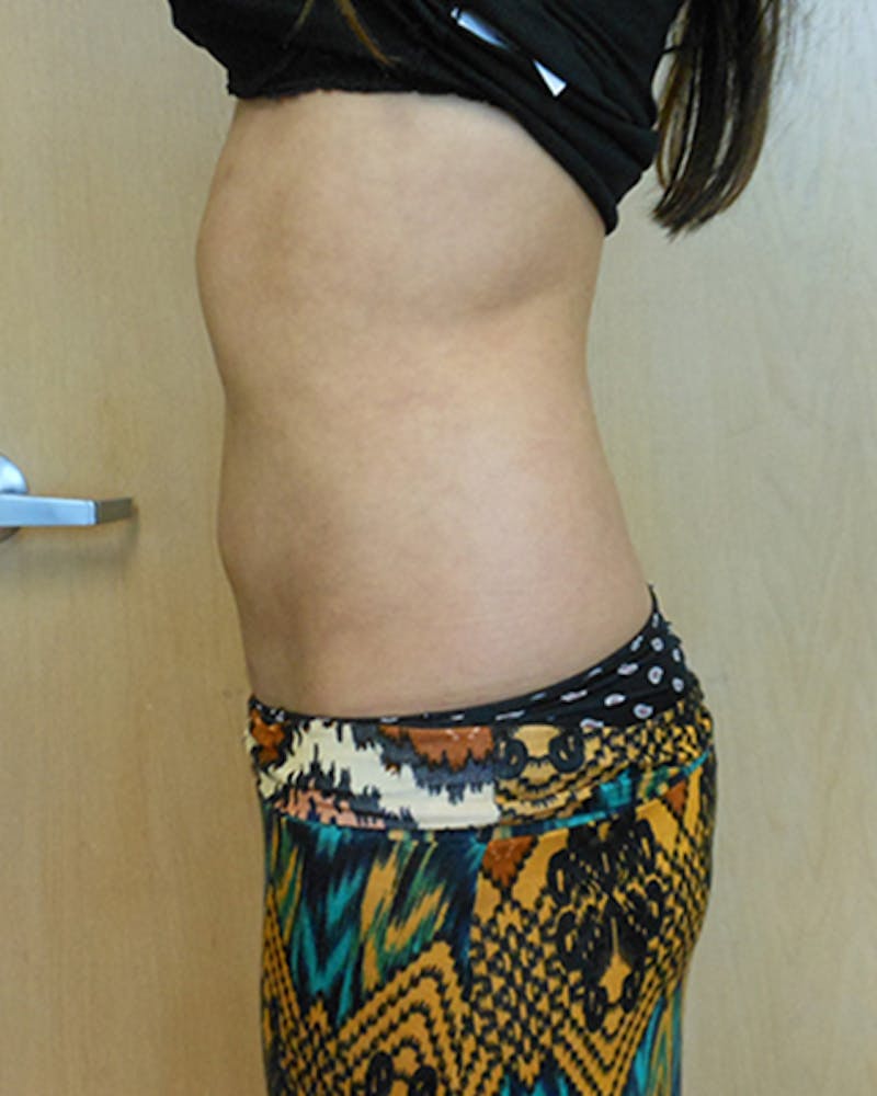 Abdomen Before & After Gallery - Patient 51821665 - Image 4