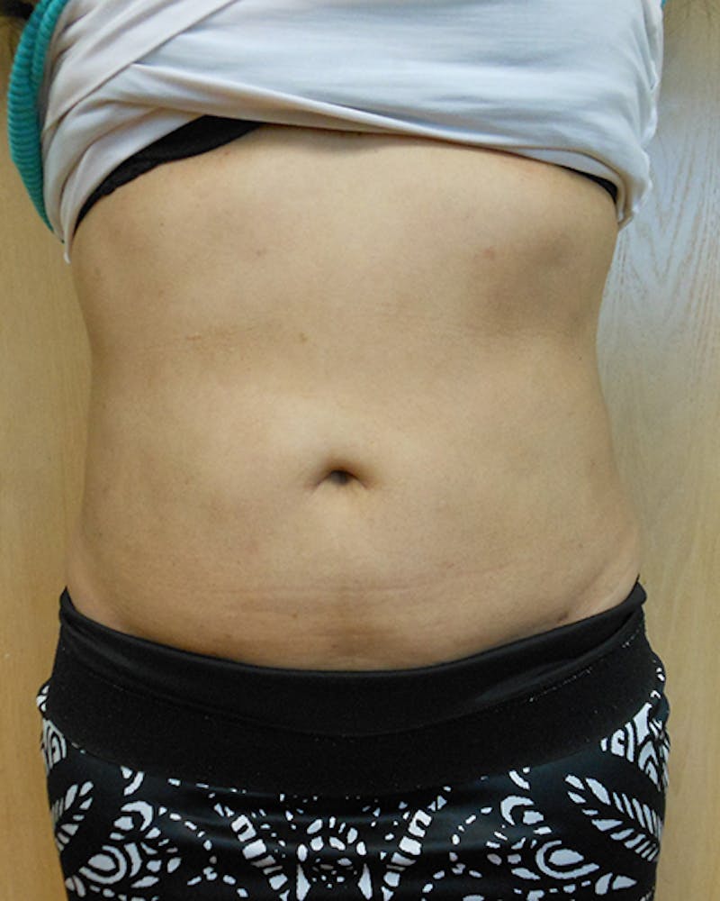 Abdomen Before & After Gallery - Patient 51821666 - Image 2