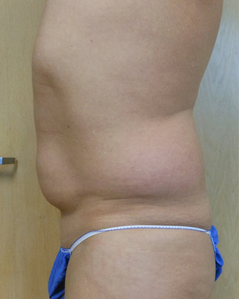 Abdomen Before & After Gallery - Patient 51821667 - Image 3