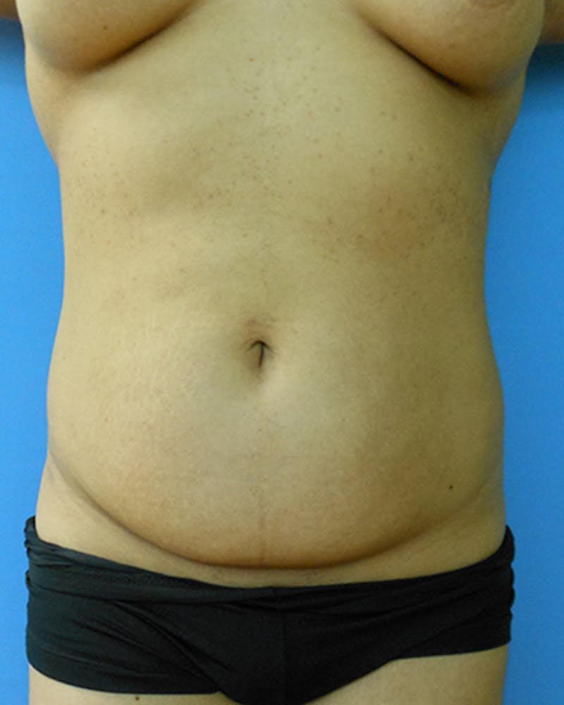 Abdomen Before & After Gallery - Patient 51821669 - Image 1