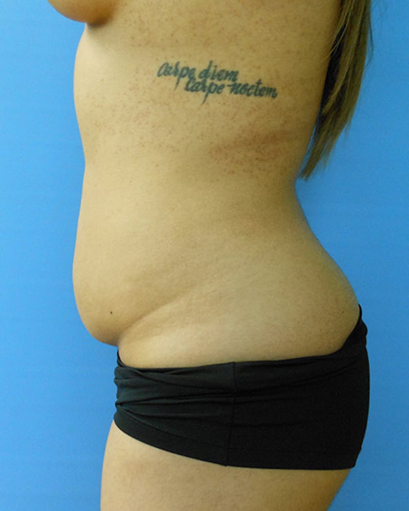 Abdomen Before & After Gallery - Patient 51821669 - Image 3