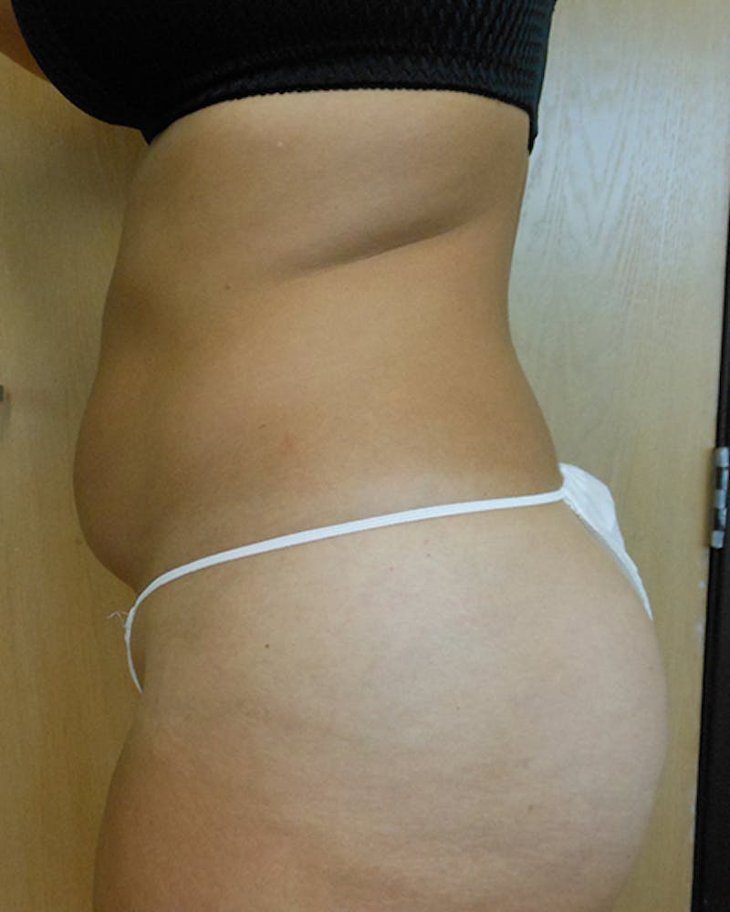Abdomen Before & After Gallery - Patient 51821670 - Image 3