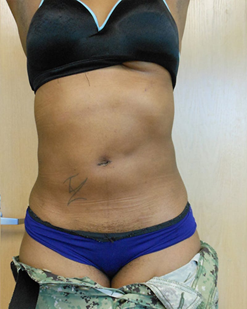 Abdomen Before & After Gallery - Patient 51821671 - Image 2