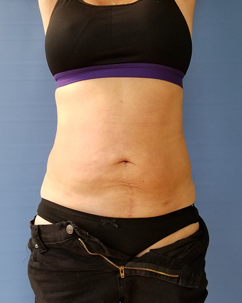 Abdomen Before & After Gallery - Patient 51821672 - Image 2