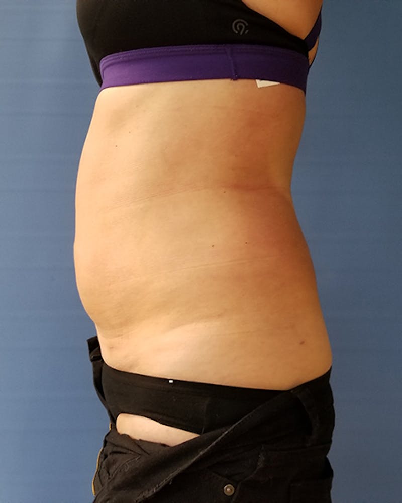 Abdomen Before & After Gallery - Patient 51821672 - Image 4