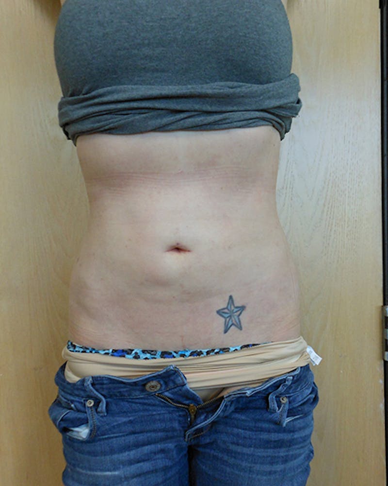 Abdomen Before & After Gallery - Patient 51821673 - Image 2