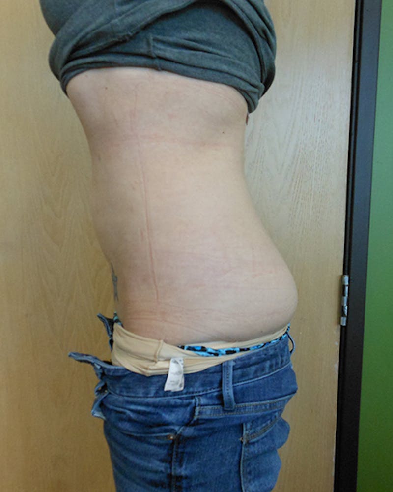 Abdomen Before & After Gallery - Patient 51821673 - Image 4