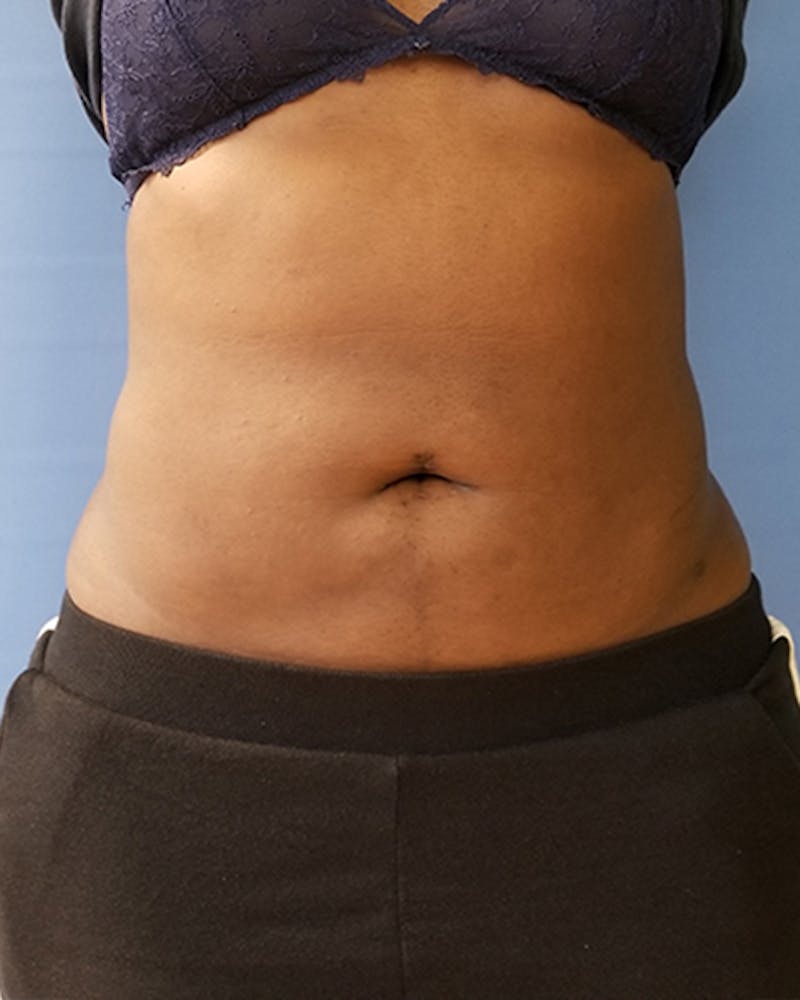 Abdomen Before & After Gallery - Patient 51821674 - Image 2