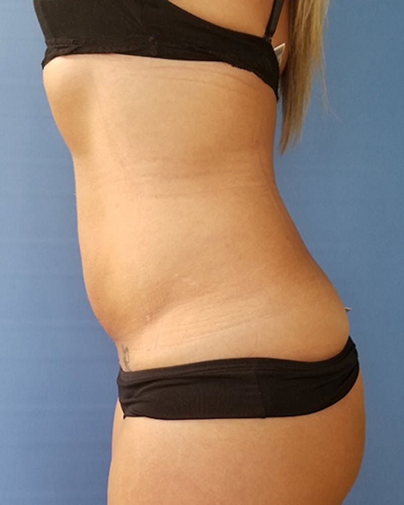 Abdomen Before & After Gallery - Patient 51821675 - Image 2