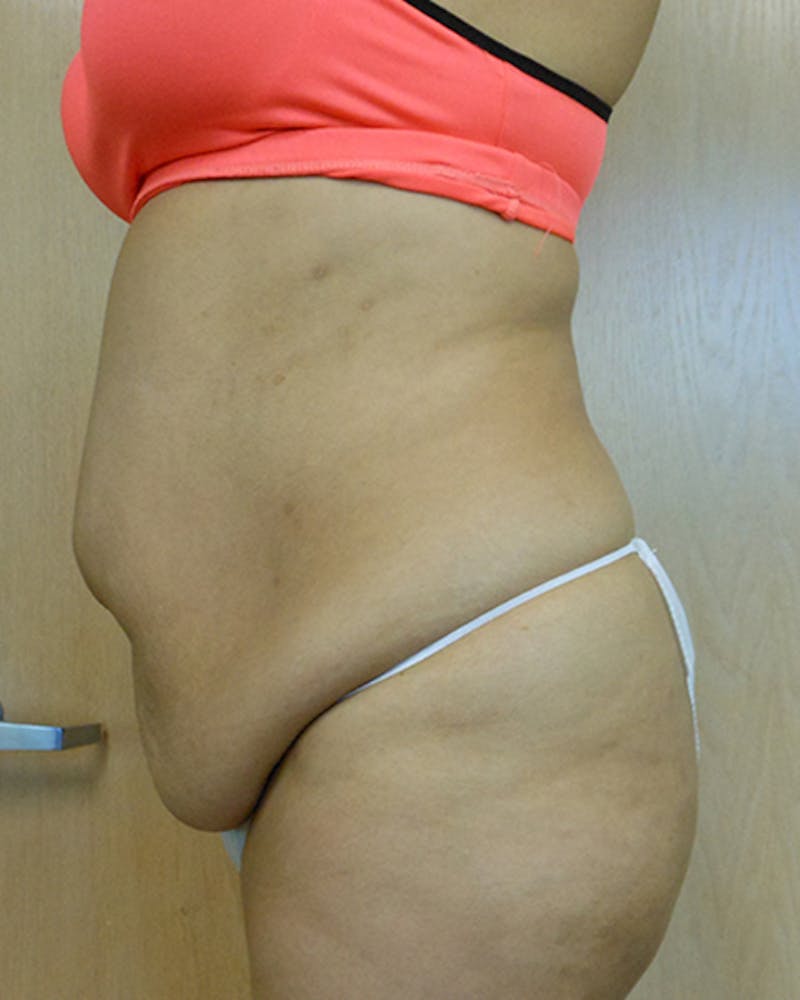 Abdomen Before & After Gallery - Patient 51821676 - Image 1