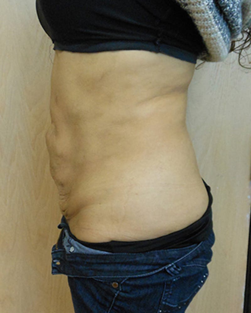 Abdomen Before & After Gallery - Patient 51821676 - Image 2