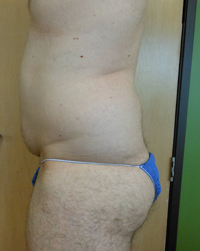 Abdomen Before & After Gallery - Patient 51821677 - Image 1