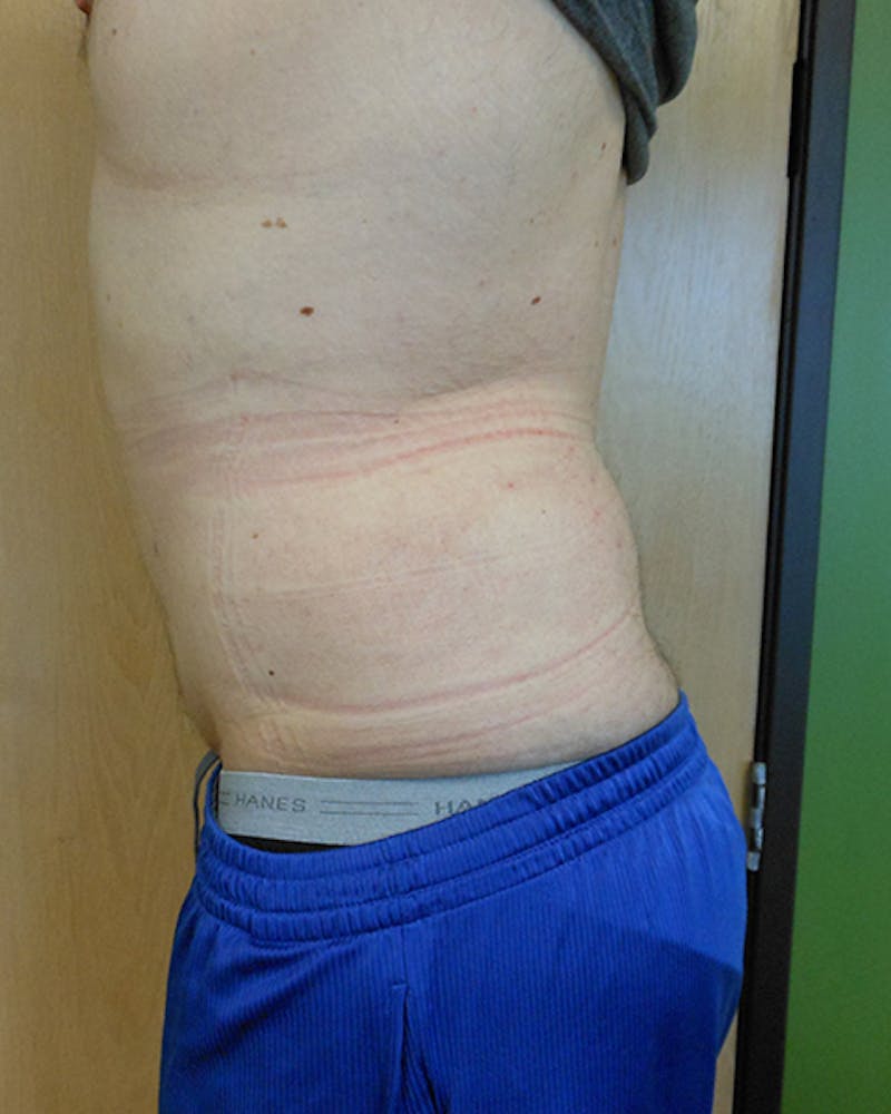 Abdomen Before & After Gallery - Patient 51821677 - Image 2