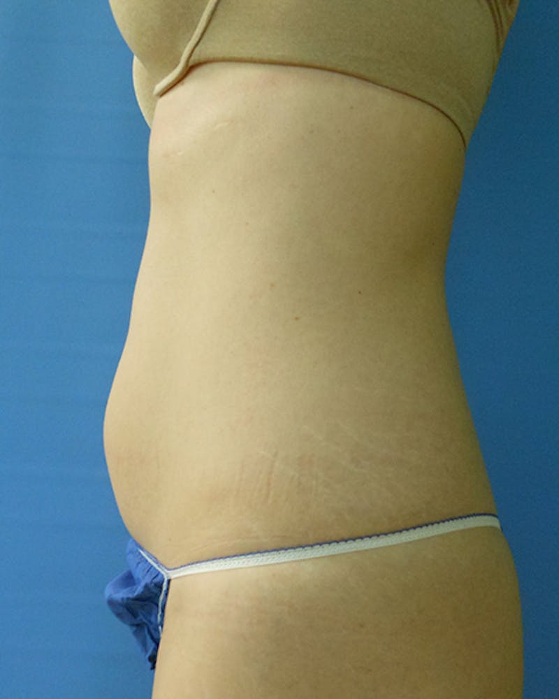 Abdomen Before & After Gallery - Patient 51821678 - Image 1