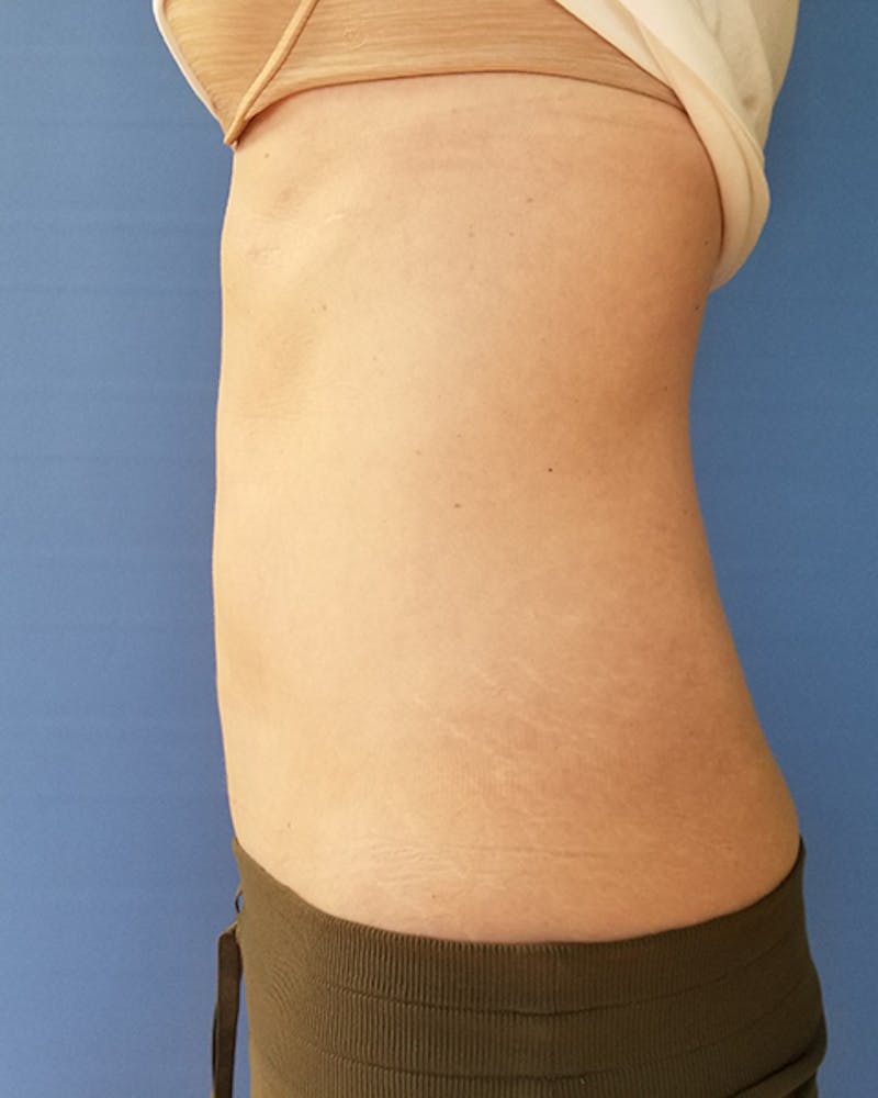 Abdomen Before & After Gallery - Patient 51821678 - Image 2