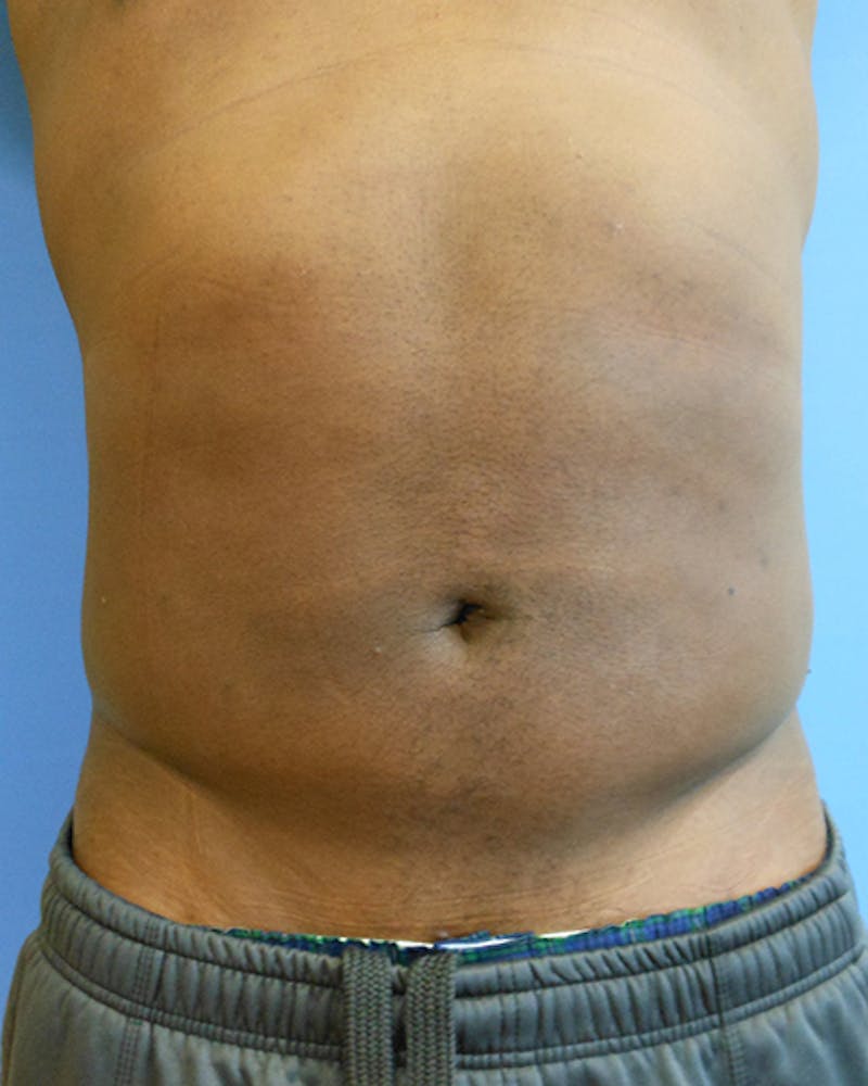 Abdomen Before & After Gallery - Patient 51821679 - Image 2