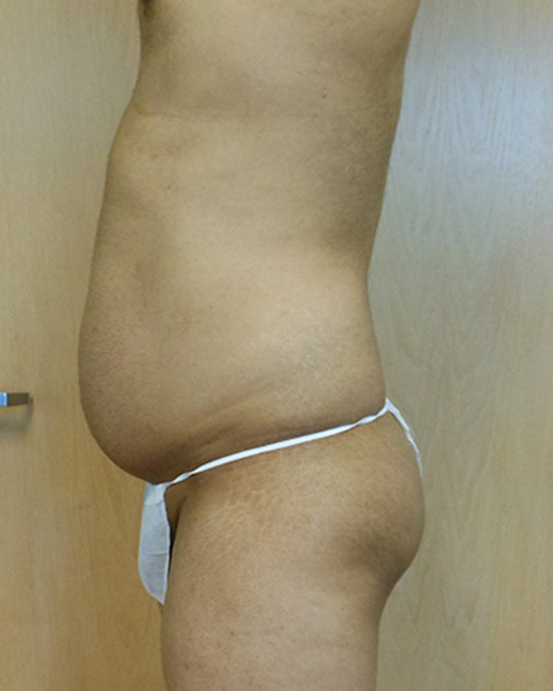 Abdomen Before & After Gallery - Patient 51821680 - Image 1