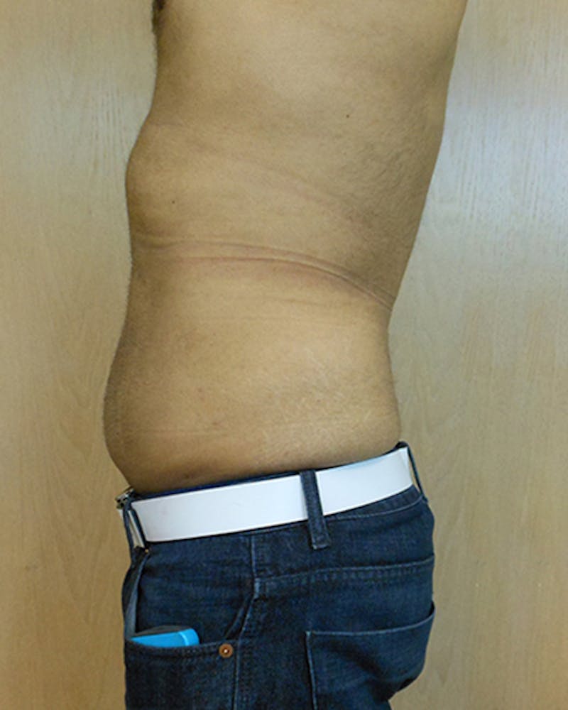Abdomen Before & After Gallery - Patient 51821680 - Image 2