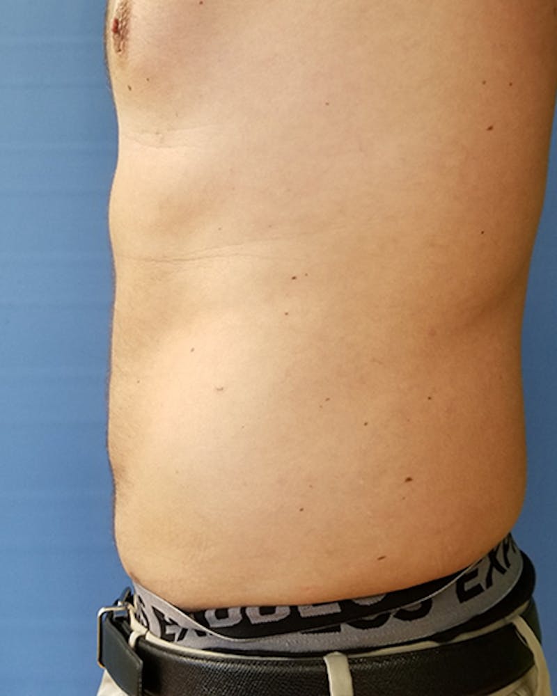 Abdomen Before & After Gallery - Patient 51821681 - Image 2