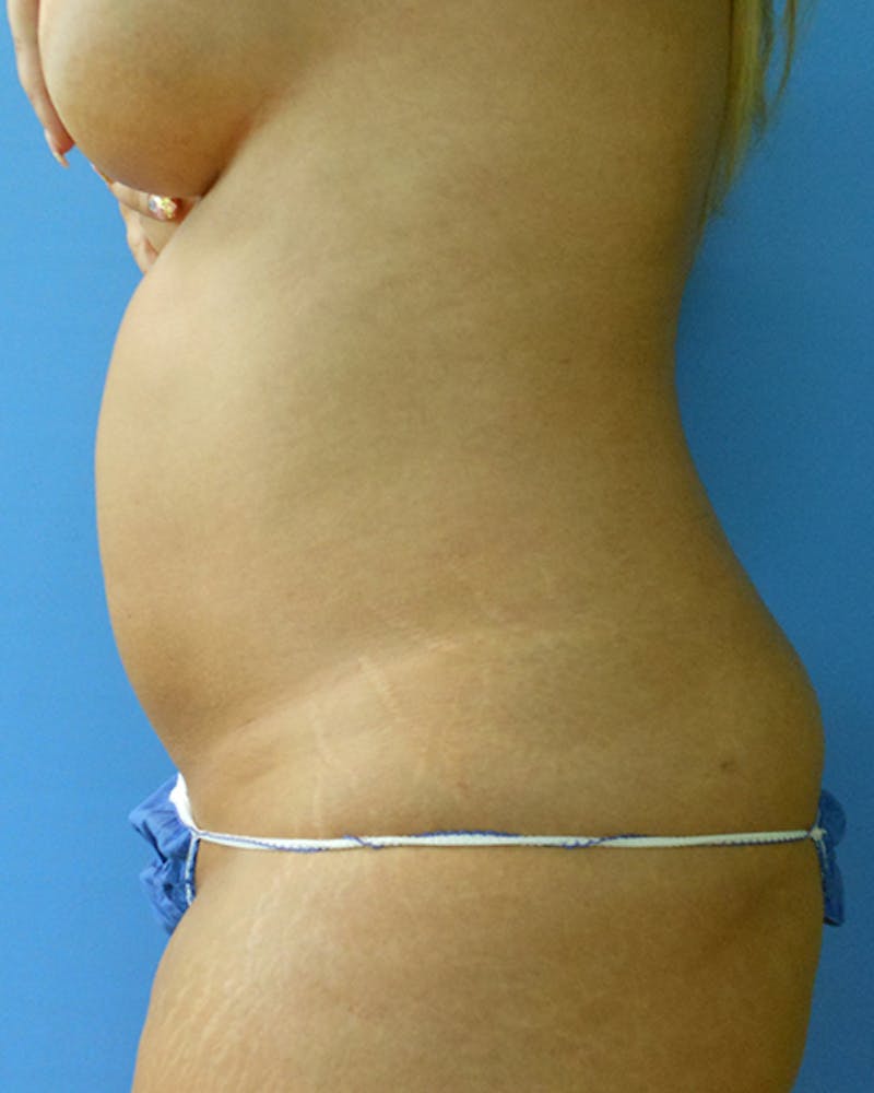 Abdomen Before & After Gallery - Patient 51821682 - Image 1
