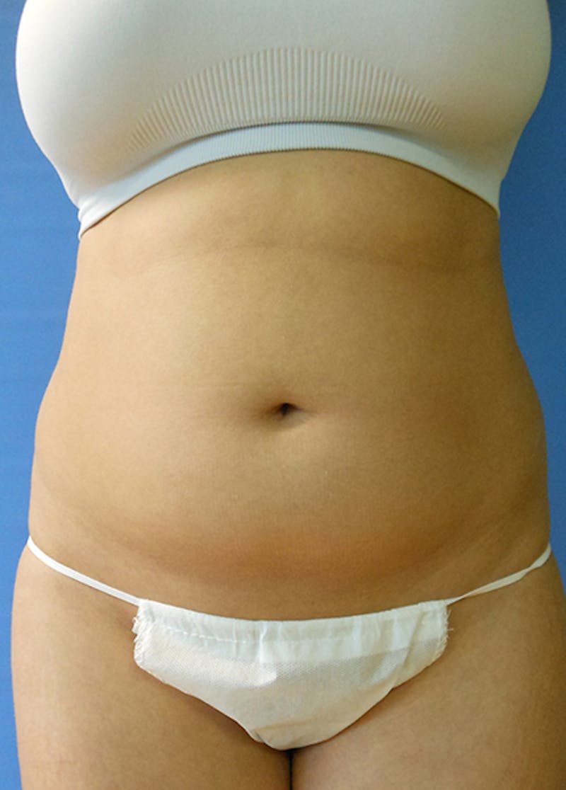 Abdomen Before & After Gallery - Patient 51821683 - Image 1