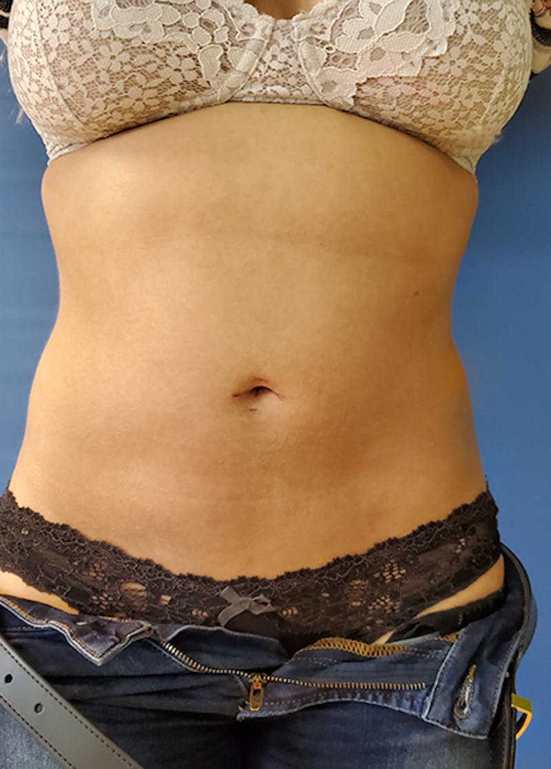 Abdomen Before & After Gallery - Patient 51821683 - Image 2
